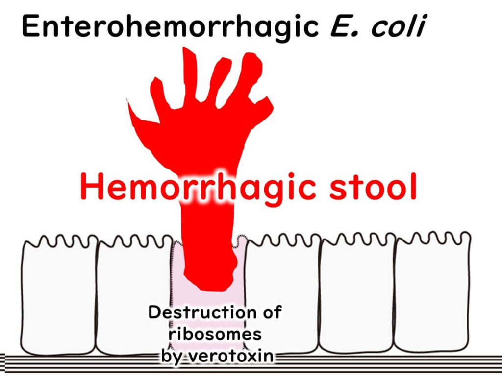 Diagram illustrating how enterohemorrhagic E. coli (EHEC) causes hemorrhagic stool by destroying ribosomes with Shiga toxin, leading to severe intestinal bleeding.