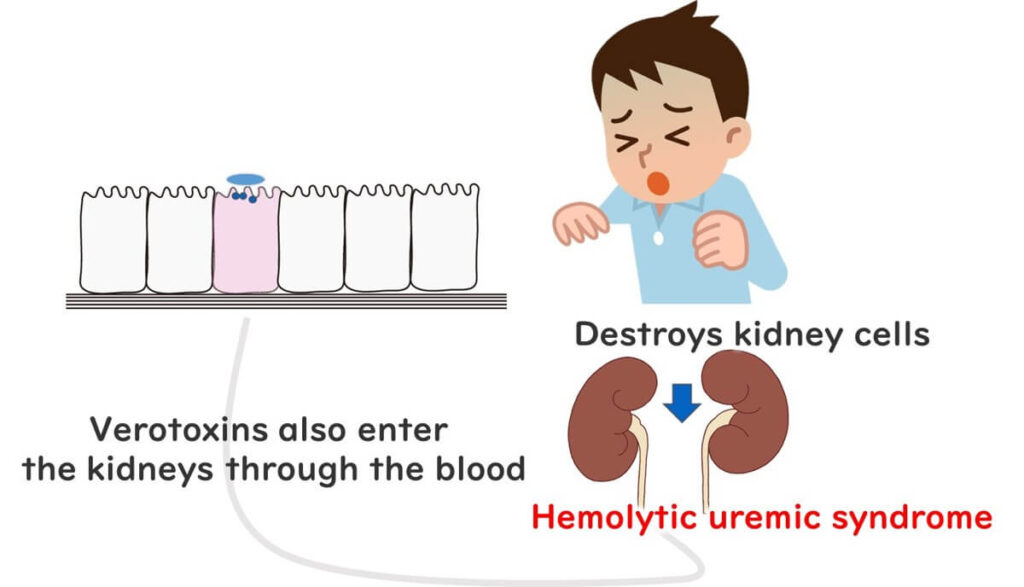 Illustration of hemolytic uremic syndrome (HUS) caused by enterohemorrhagic E. coli (EHEC), showing how Shiga toxin enters the kidneys through the blood, leading to kidney cell destruction.