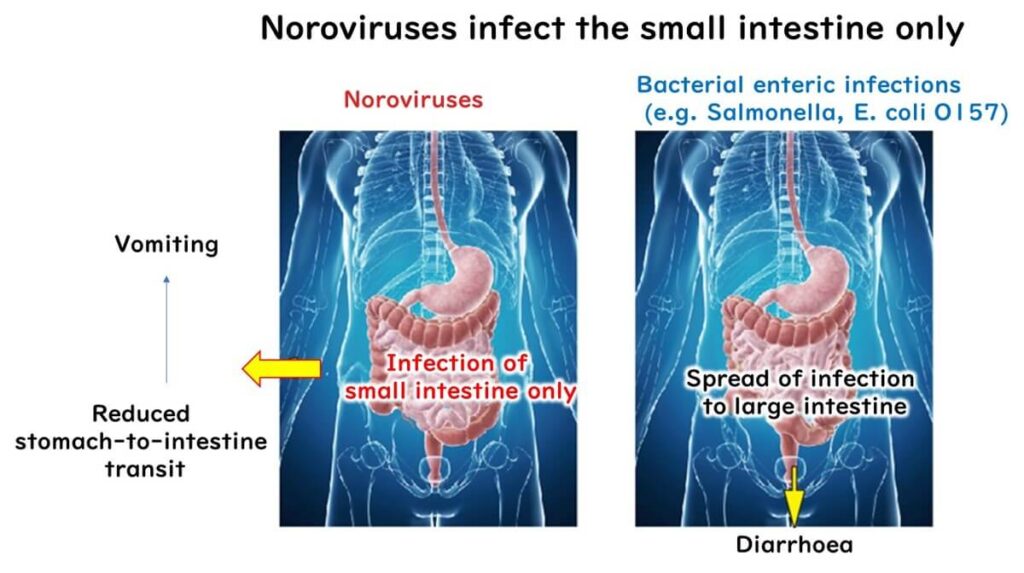 Comparison of norovirus infection and bacterial enteric infections: Noroviruses infect only the small intestine, causing vomiting, while bacterial infections spread to the large intestine, leading to diarrhea.