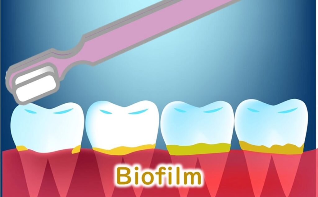 Biofilm on teeth