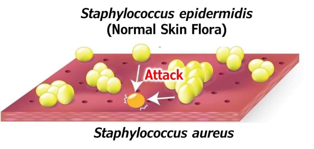 Diagram showing Staphylococcus epidermidis (normal skin flora) attacking Staphylococcus aureus on the skin surface, illustrating the protective role of beneficial skin bacteria.